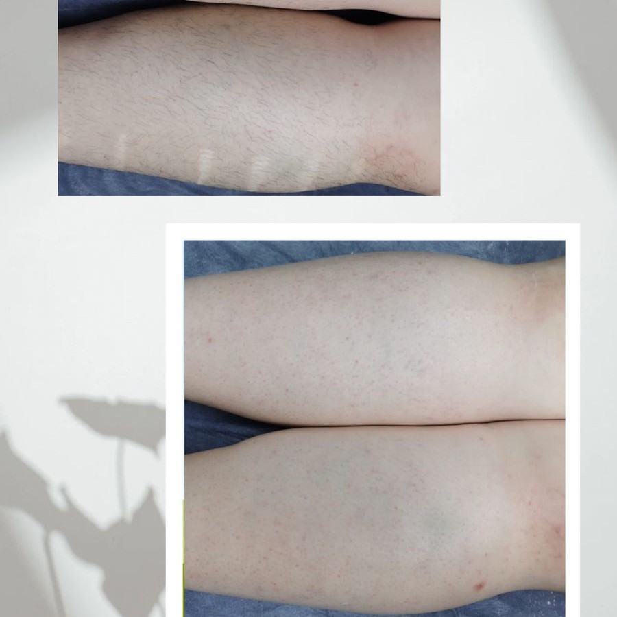 Восковая депиляция зоны голеней включая колени