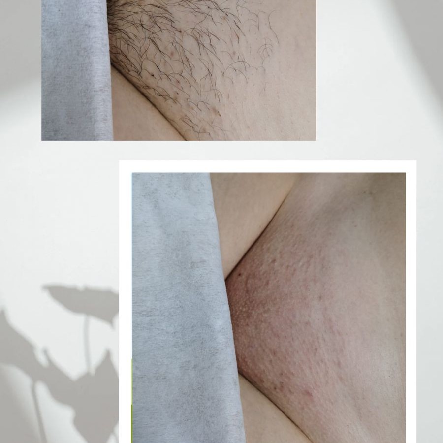 Восковая депиляция зоны бикини глубокое