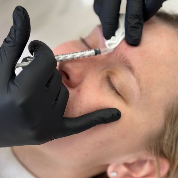 Ботулинотерапия Лоб + межбровье + "гусиные лапки" + нос