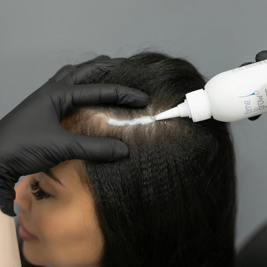 Пилинг кожи головы.