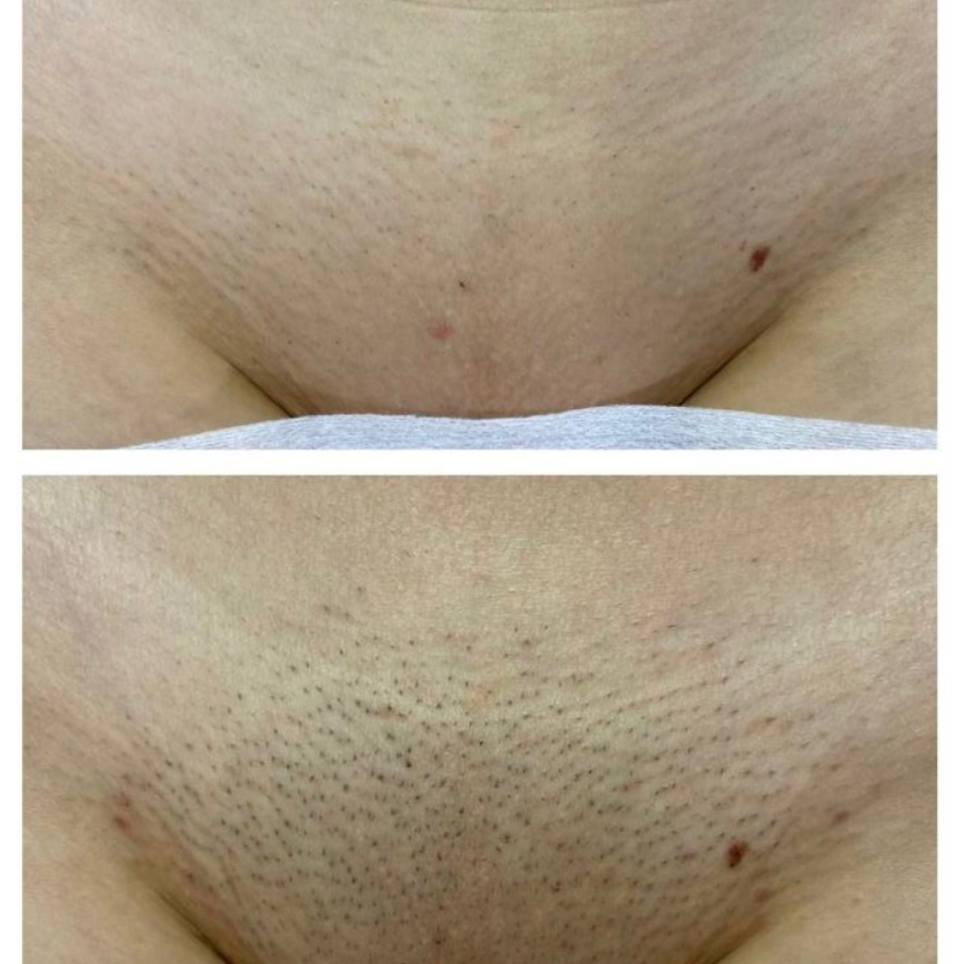 Глубокое бикини