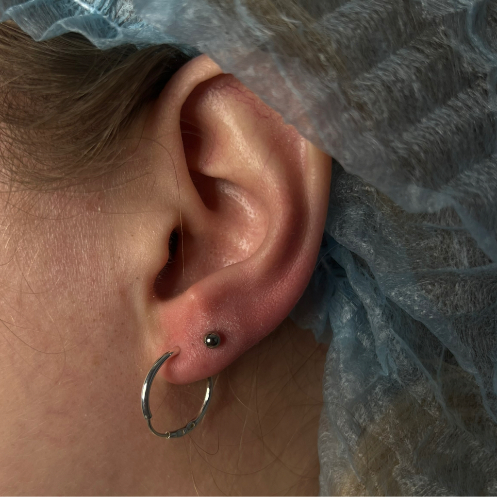 Прокол двух мочек