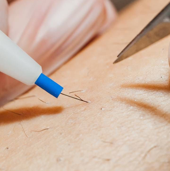 Электроэпиляция