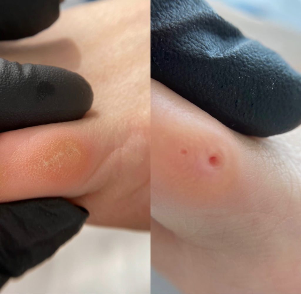 Удаление стрежневой мозоли