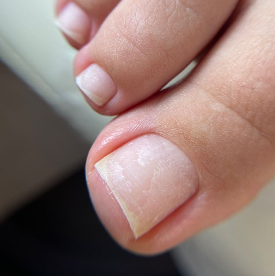 Снятие покрытия с пальцев ног и приданием формы