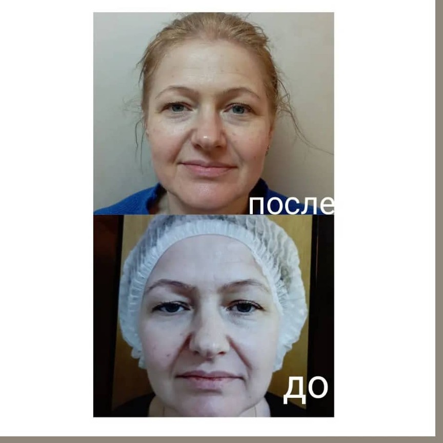 SMAS нижняя треть лица