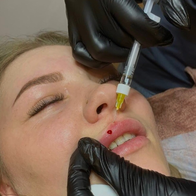 Аугментация губ ( 1ml )  Juvederm ; Stylage