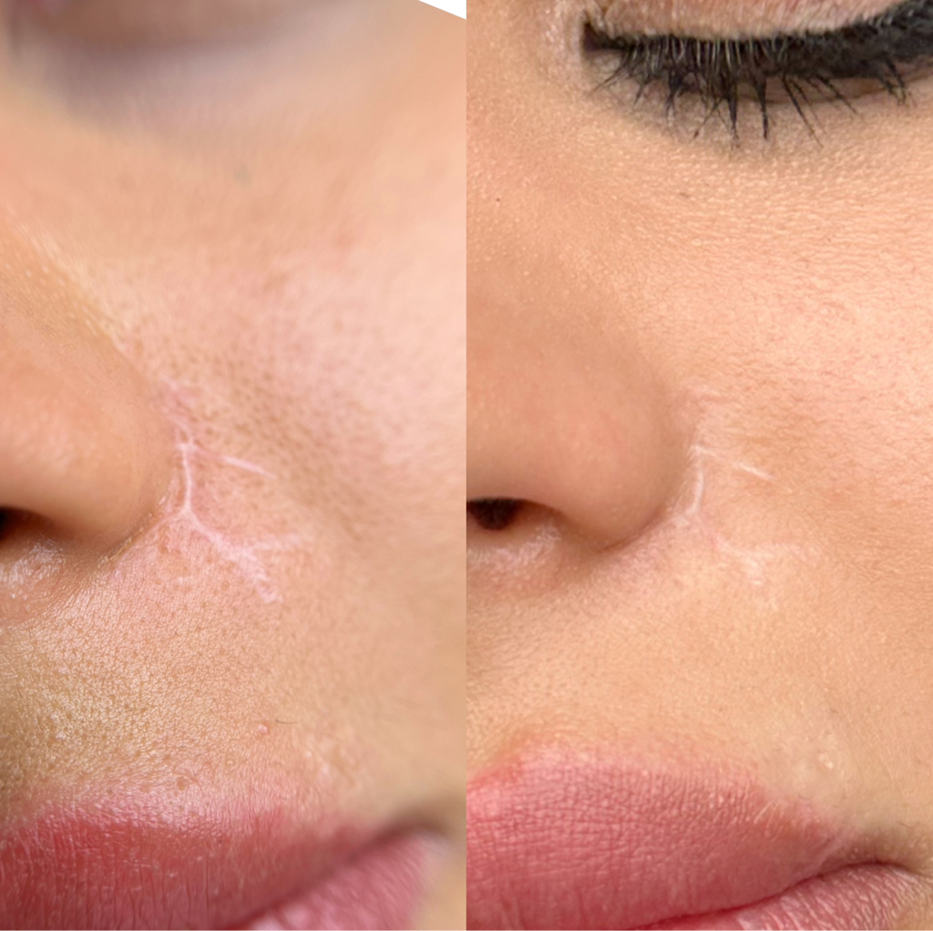 Удаление рубцов ( пришлите фото рубца для онлайн консультации)