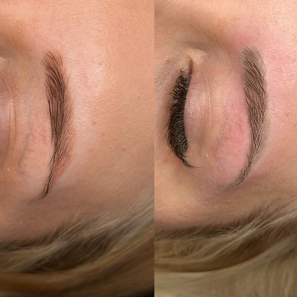 Удаление лазером