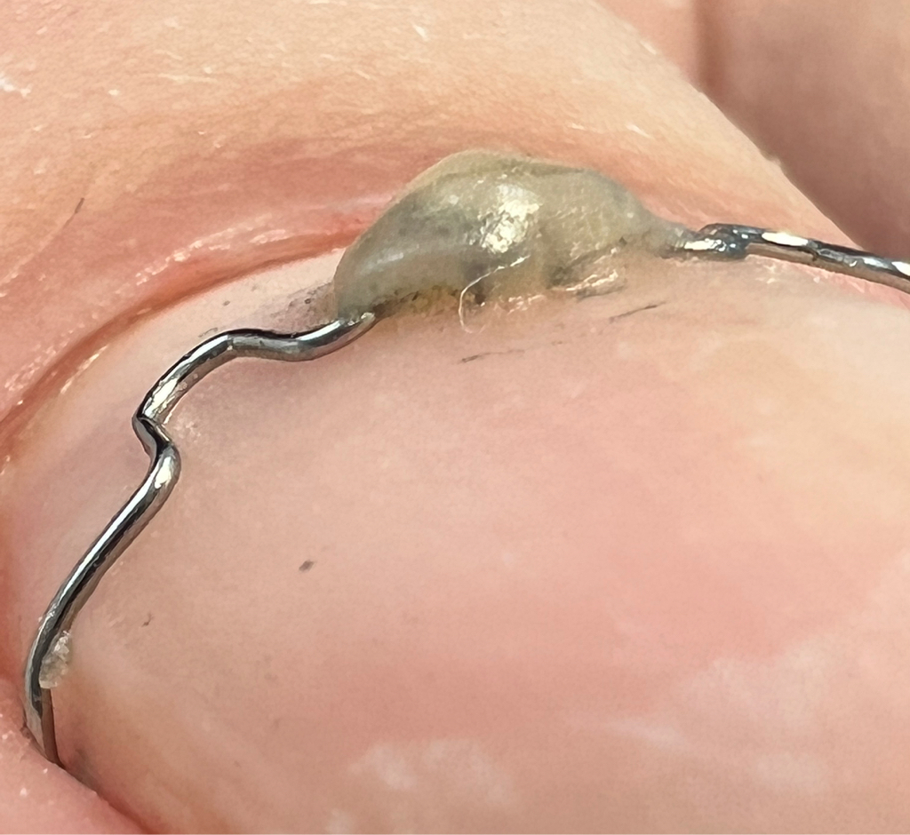 Установка ЗТО ( крючковая коррекционная система)