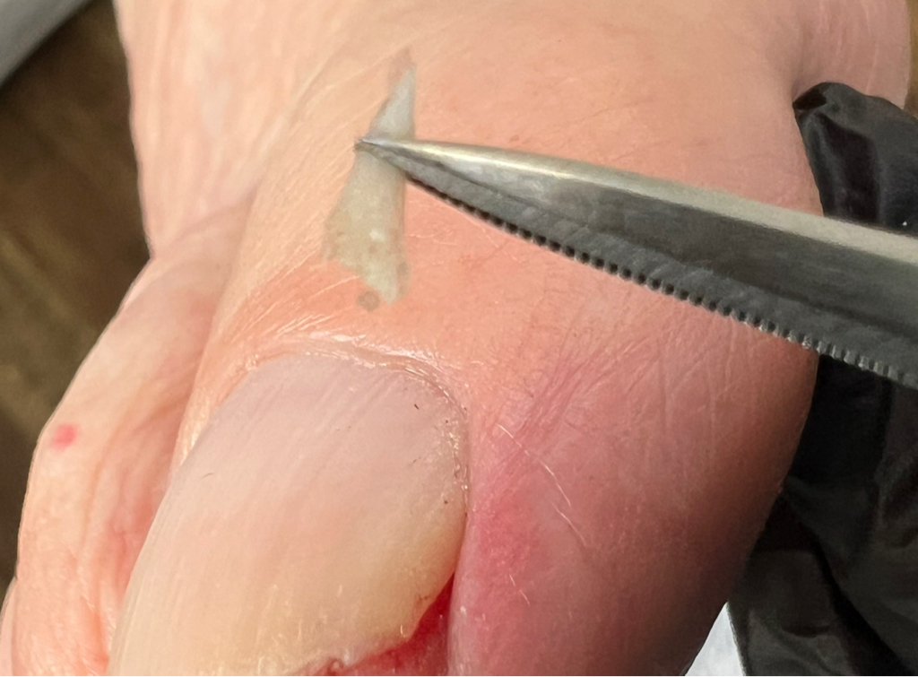 Обработка вросшего сегмента 1 степень ( легкое покраснение, несильная боль)