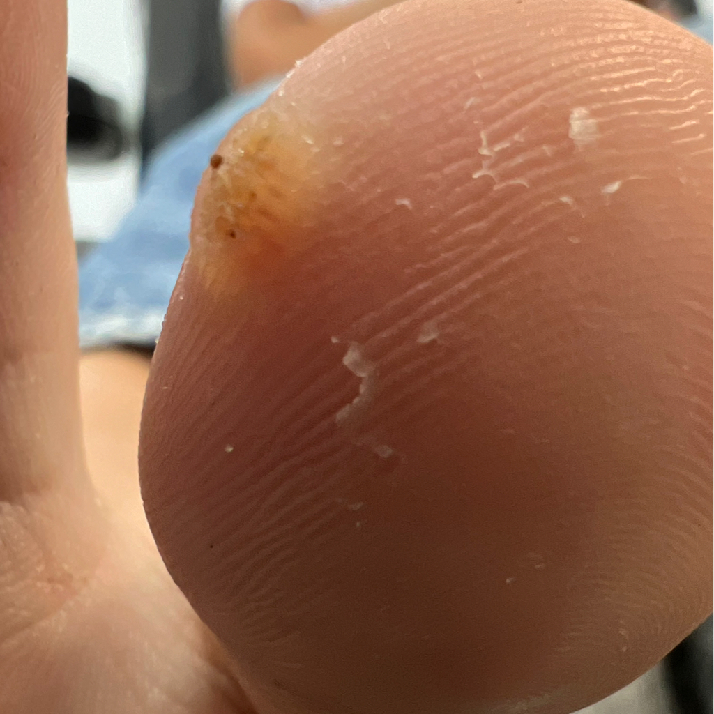 Обработка впч (первичный прием)