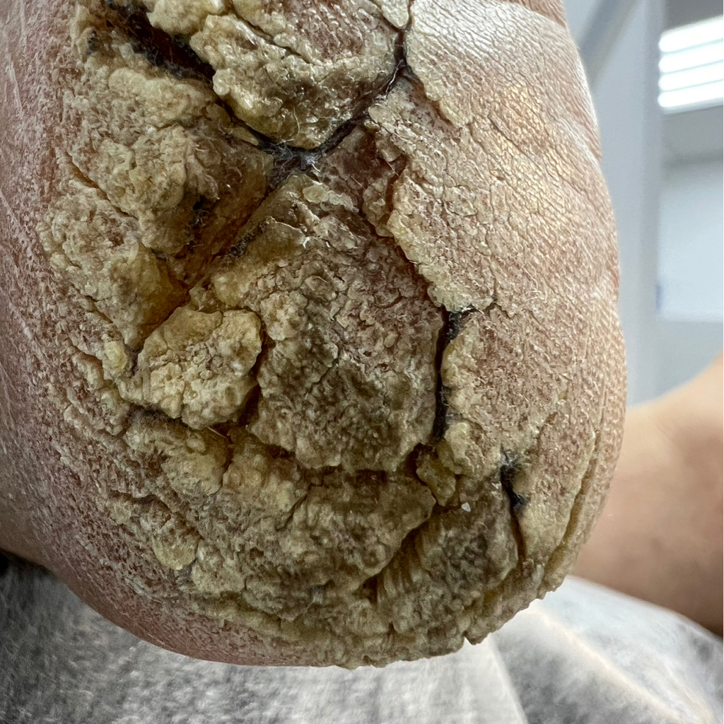 Зачистка микоза нп и стоп