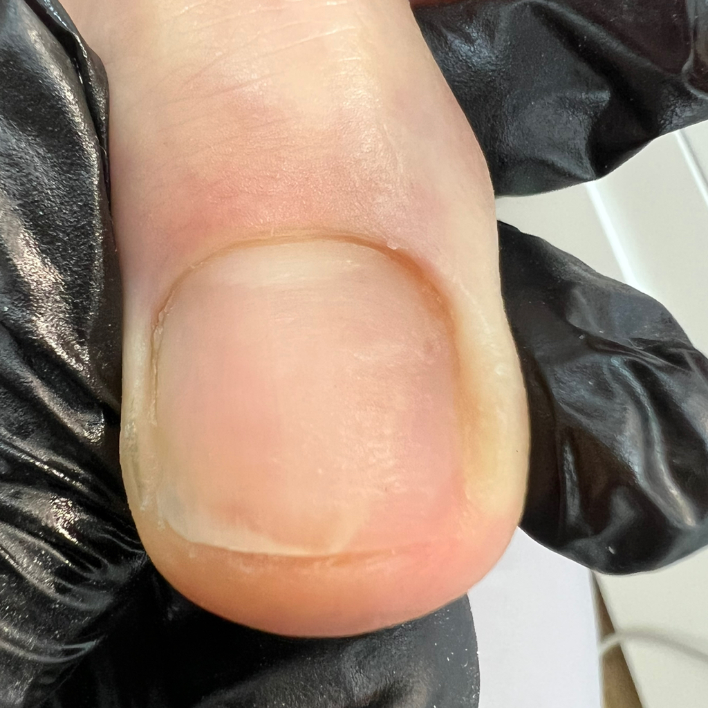 Протезирование нп