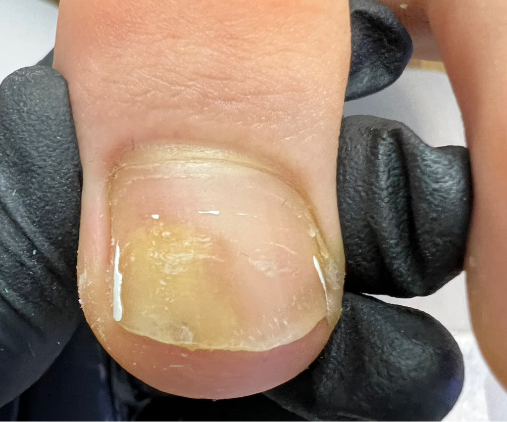 Зачистка онихолизиса