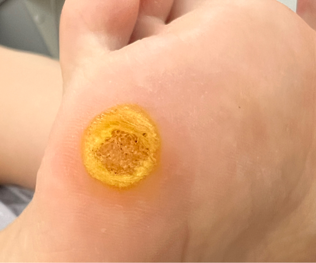 Обработка ВПЧ ( повторный прием )