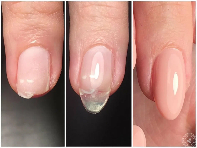 Ремонт одного ногтя