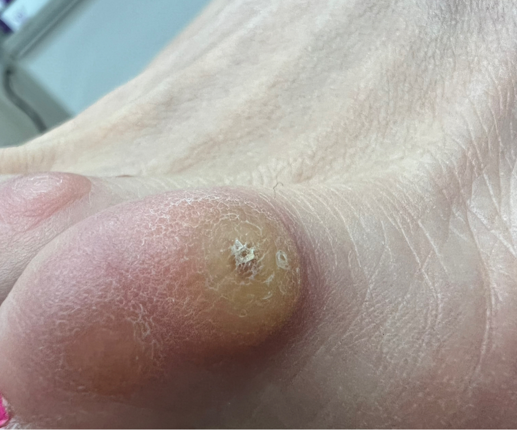 Обработка стержневой мозоли