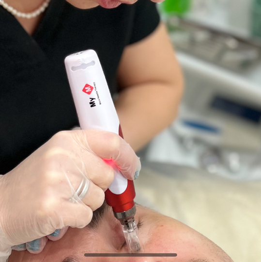 Микродермабразия (лицо)