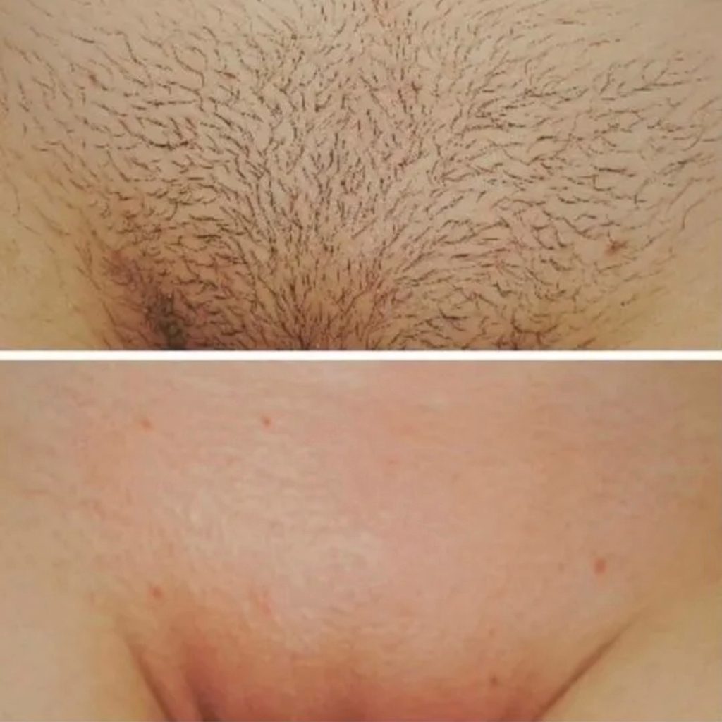 Комплекс лазерной эпиляции глубокое бикини+подмышки+ ноги полностью   7 сеансов