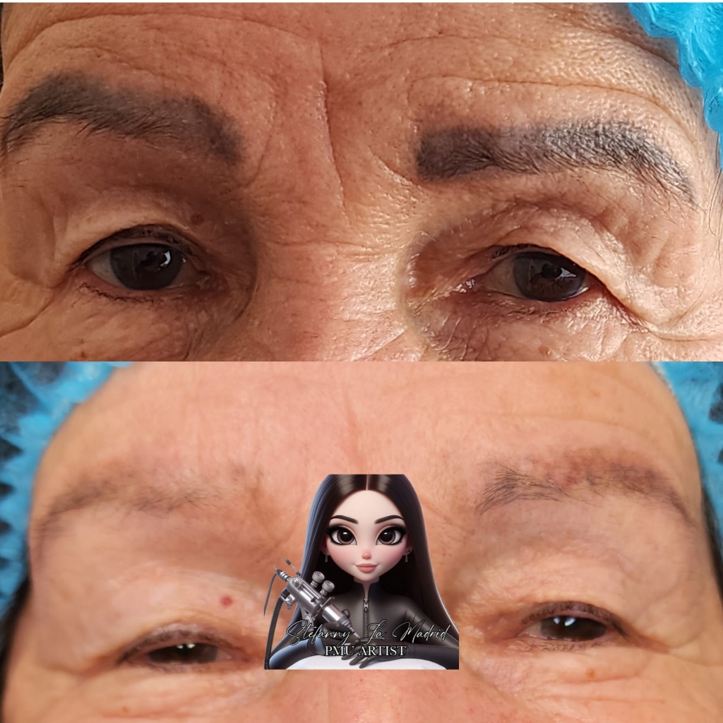 REMOCION LÁSER - CEJAS y LABIOS