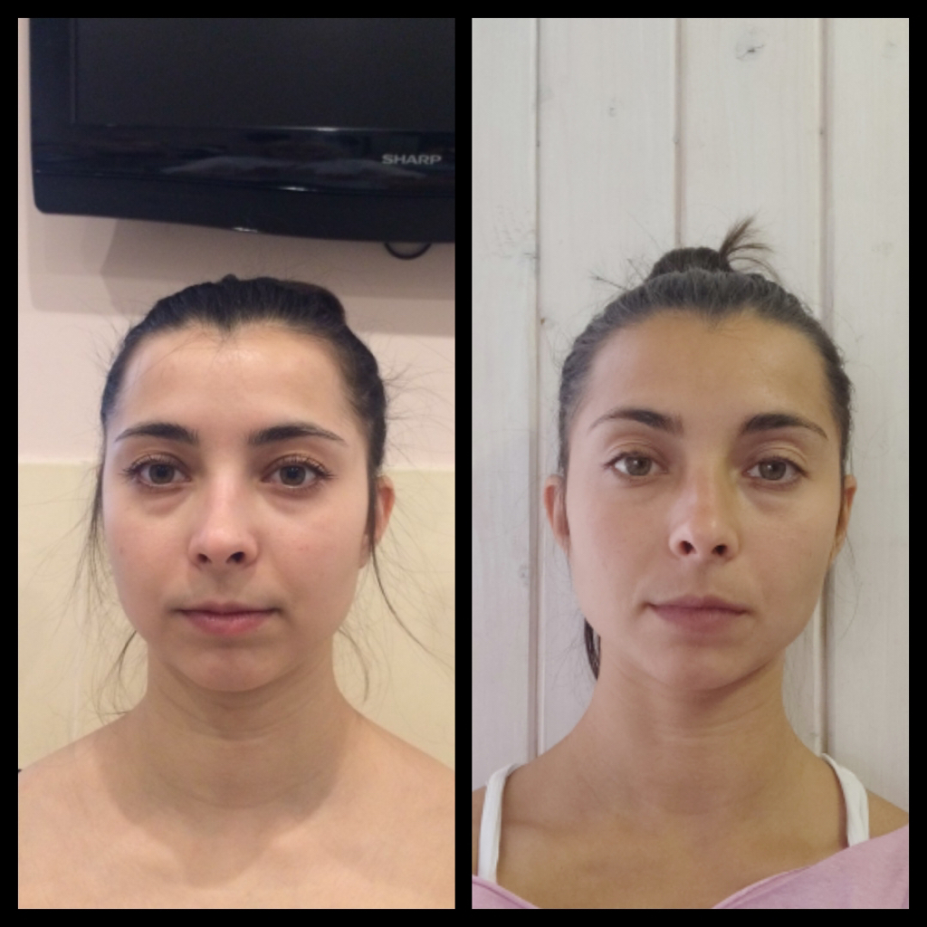 Фасциальная пластика лица (60 мин)