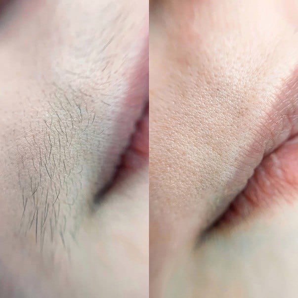 Удаление пушка над губой