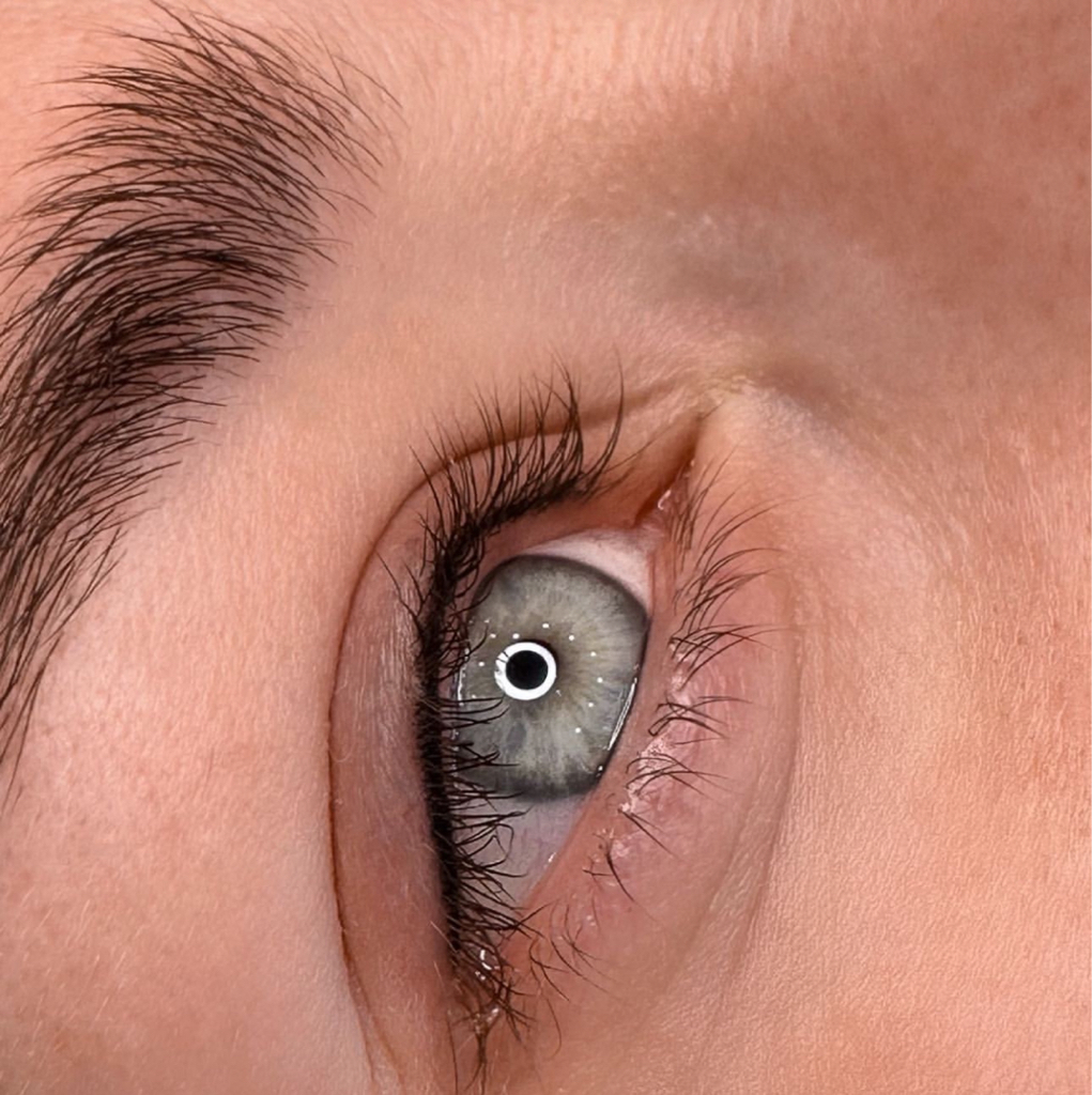 Коррекция МЕЖРЕСНИЧКА