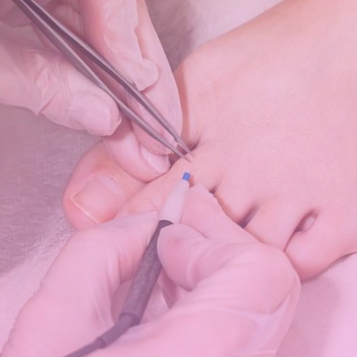 Электроэпиляция 3 часа