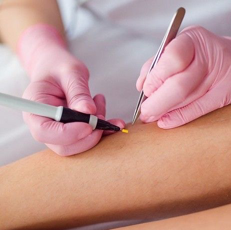 Электроэпиляция 1 час