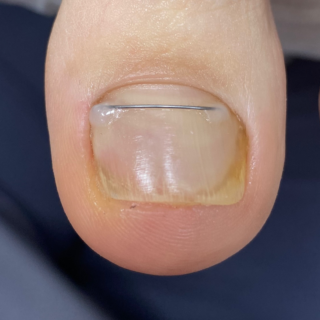 Коррекция титановой нити