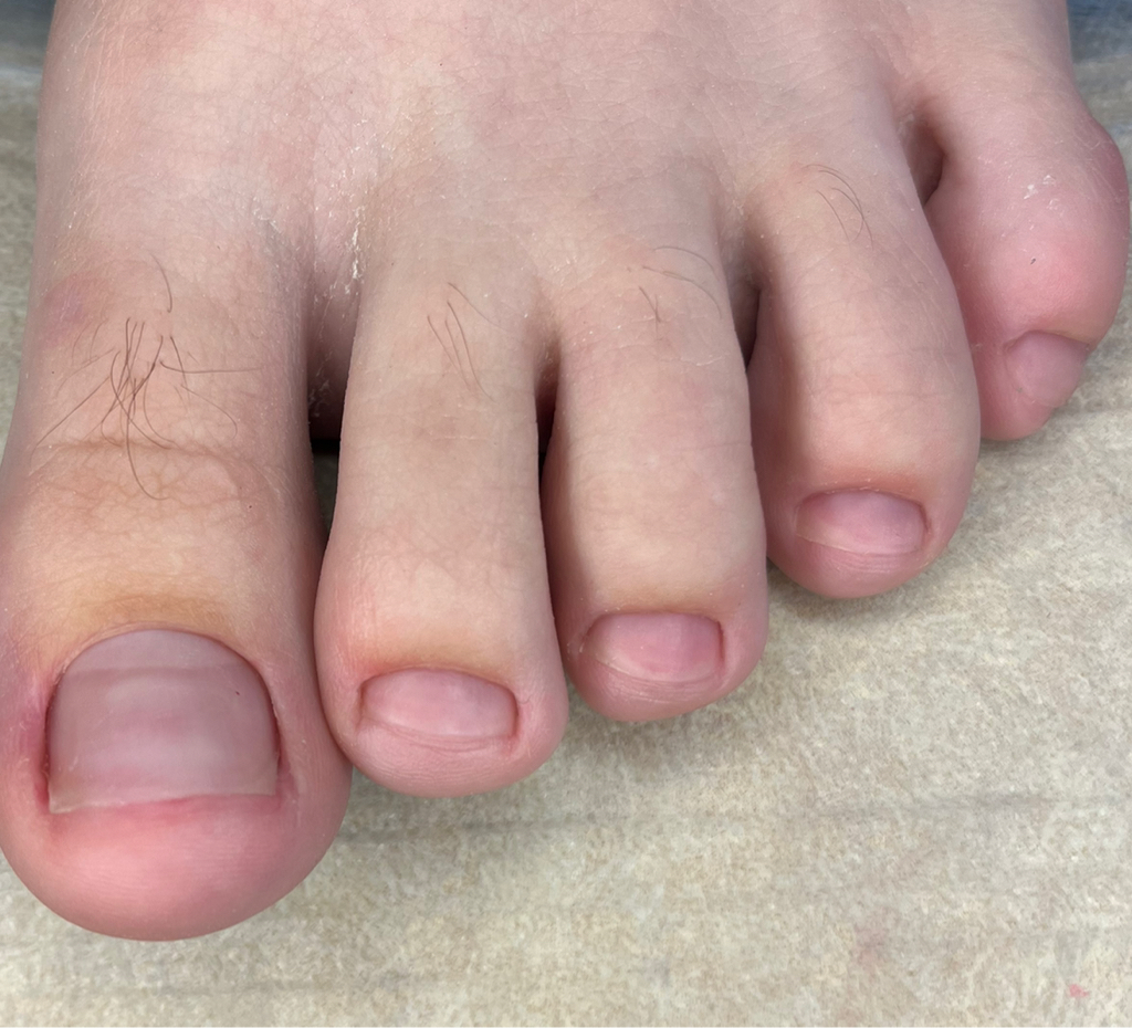 Пальчики ног без покрытия