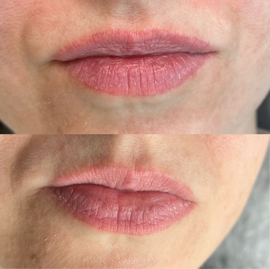 Удаление татуажа губ (лазер)