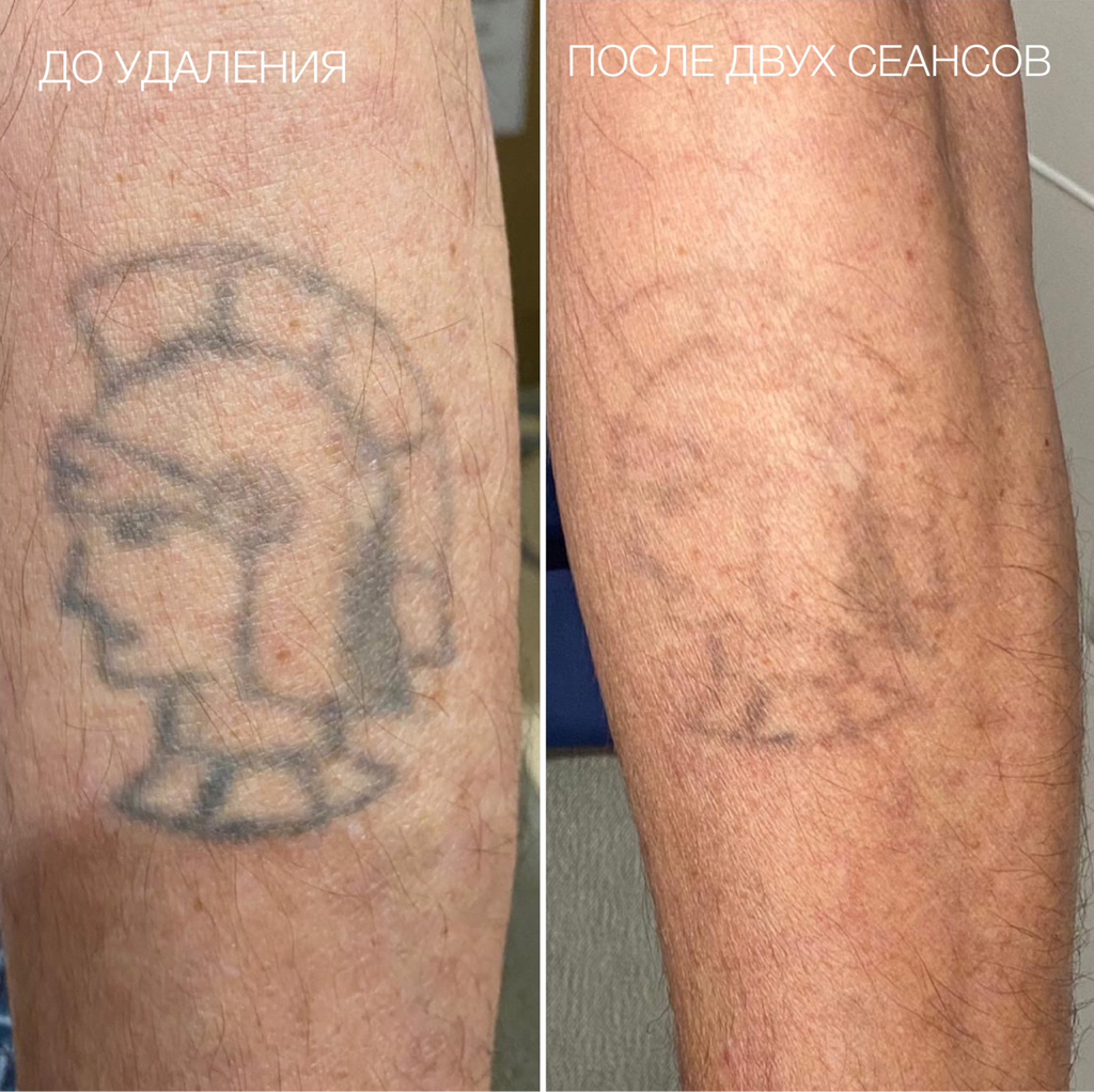Удаление тату