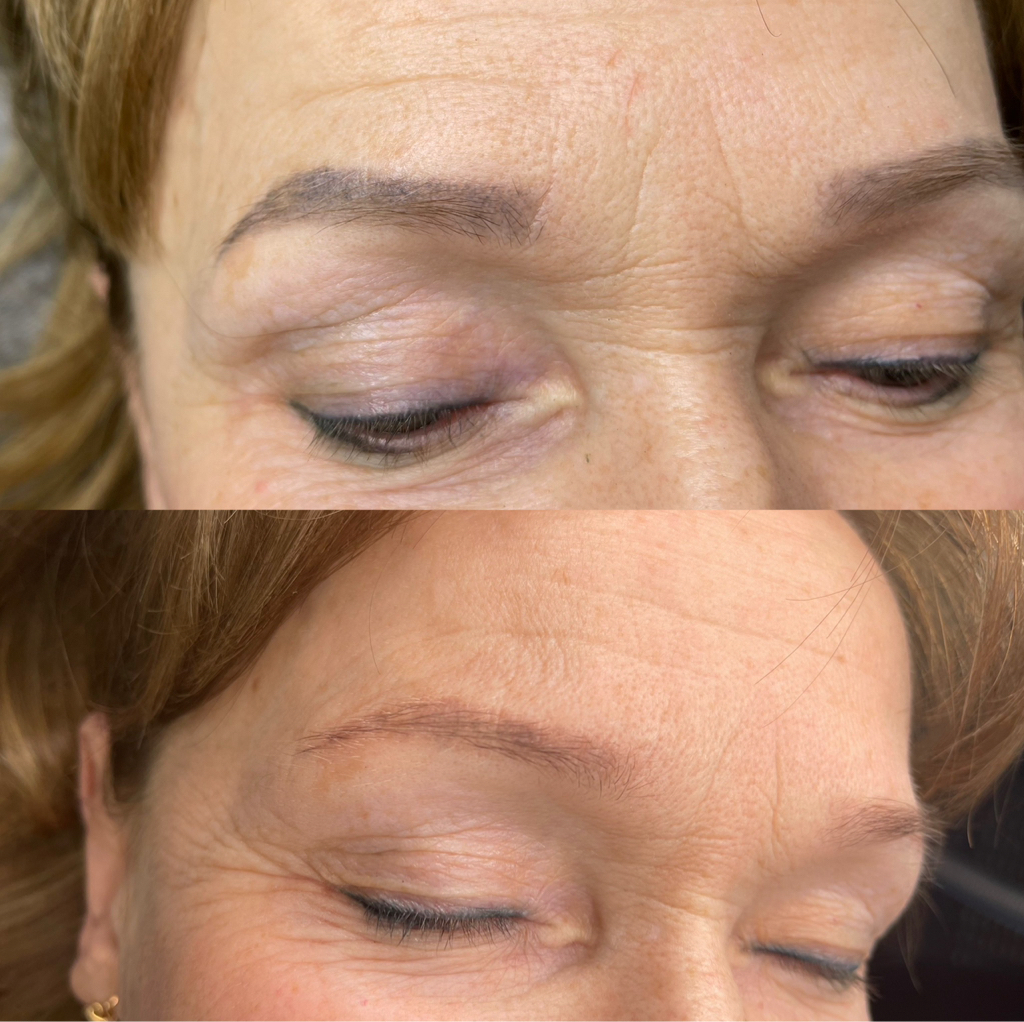 Удаление татуажа бровей (лазер)