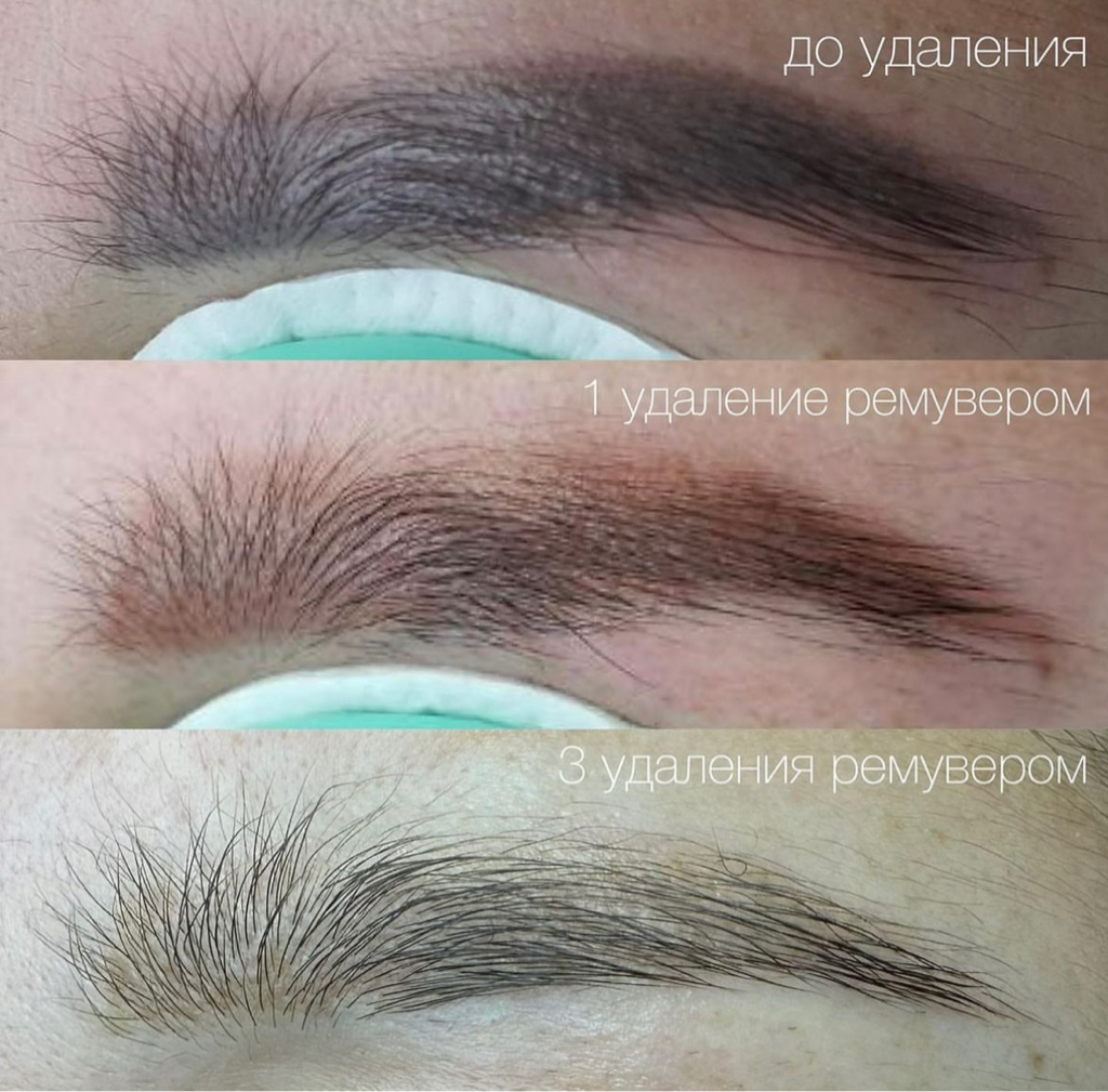 Entfernen von veralteten (minderwertigen) Permanent Make-up mit Remover