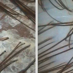 ТРИХОСКОПИЯ И ПИЛИНГ