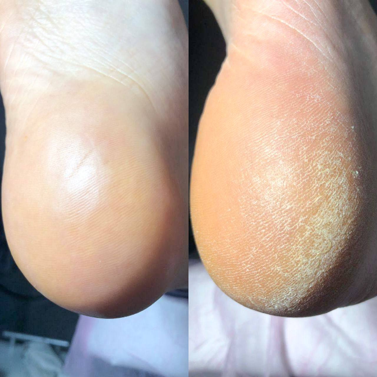 Обработка стопы (Smart техника)