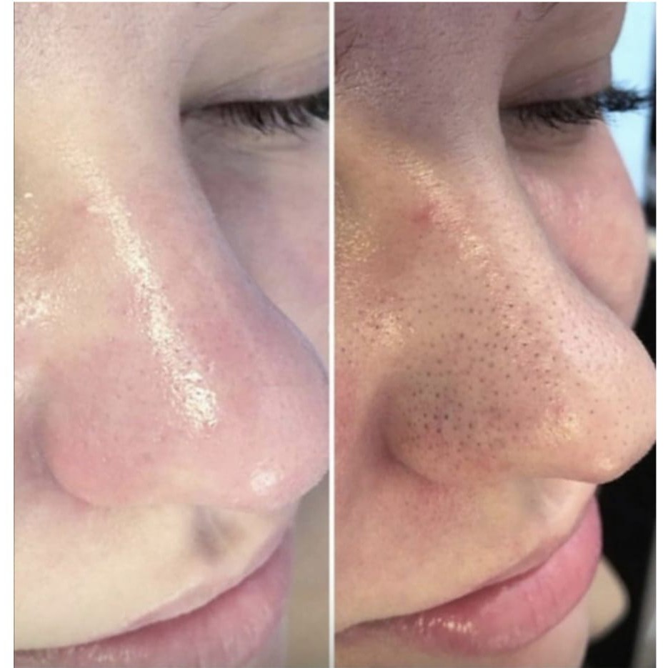 комбинированная чистка лица