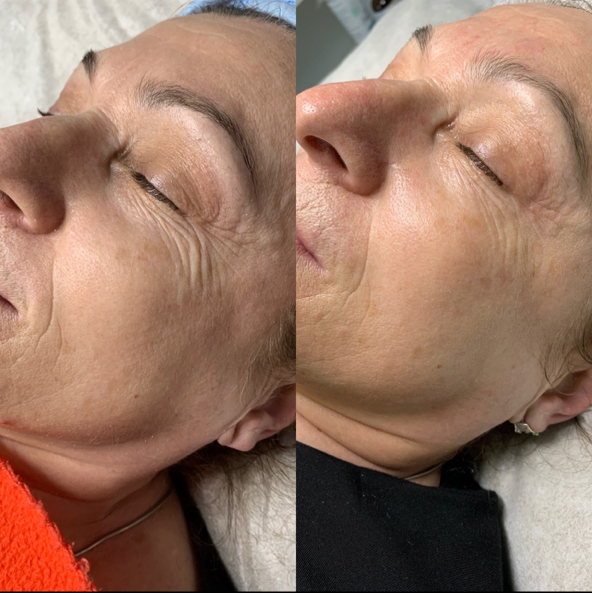 FlaxLift