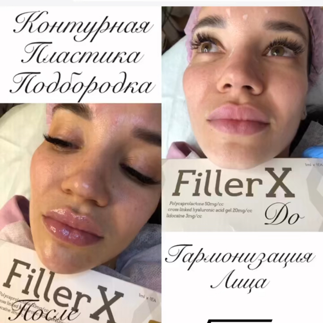 Коррекция подбородка. Контурная пластика подбородка.