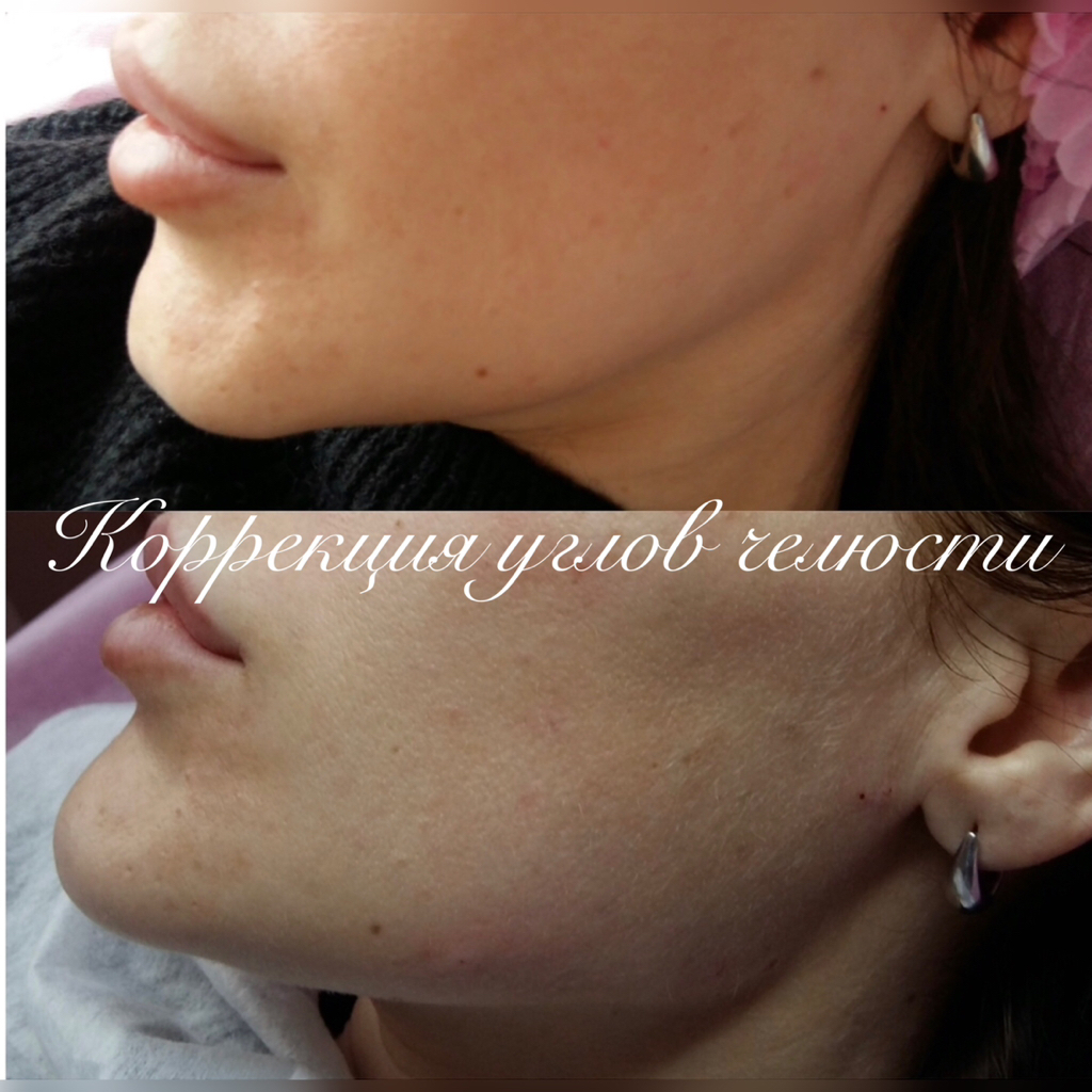 Углы челюсти. Гармонизация лица. Треугольник молодости.