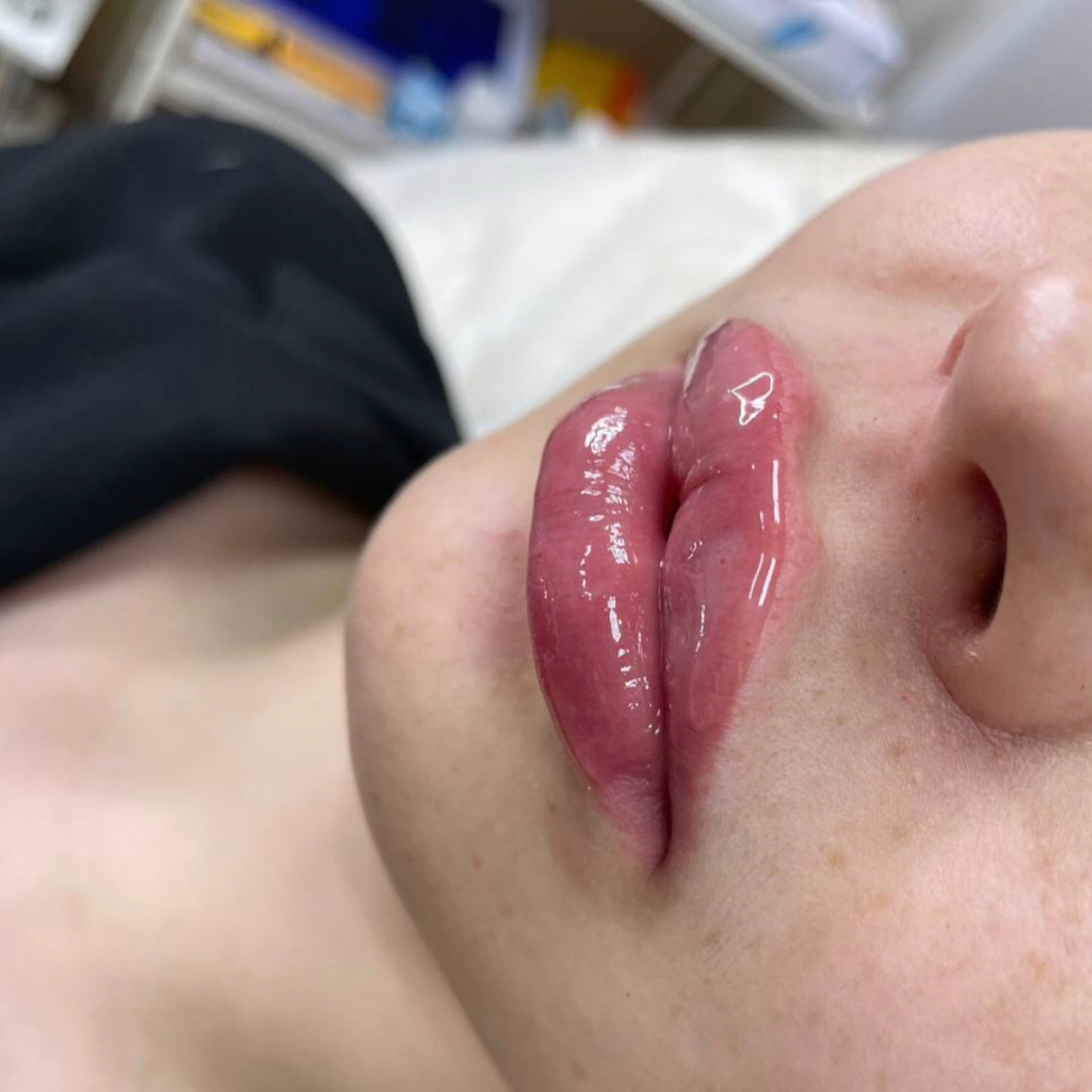 Увеличение губ.2 сессия.