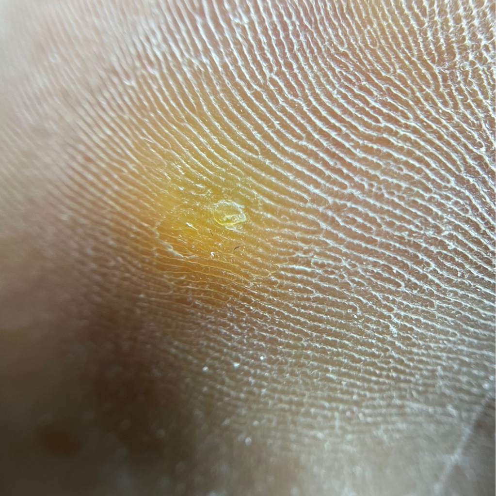 Обработка стержневой мозоли