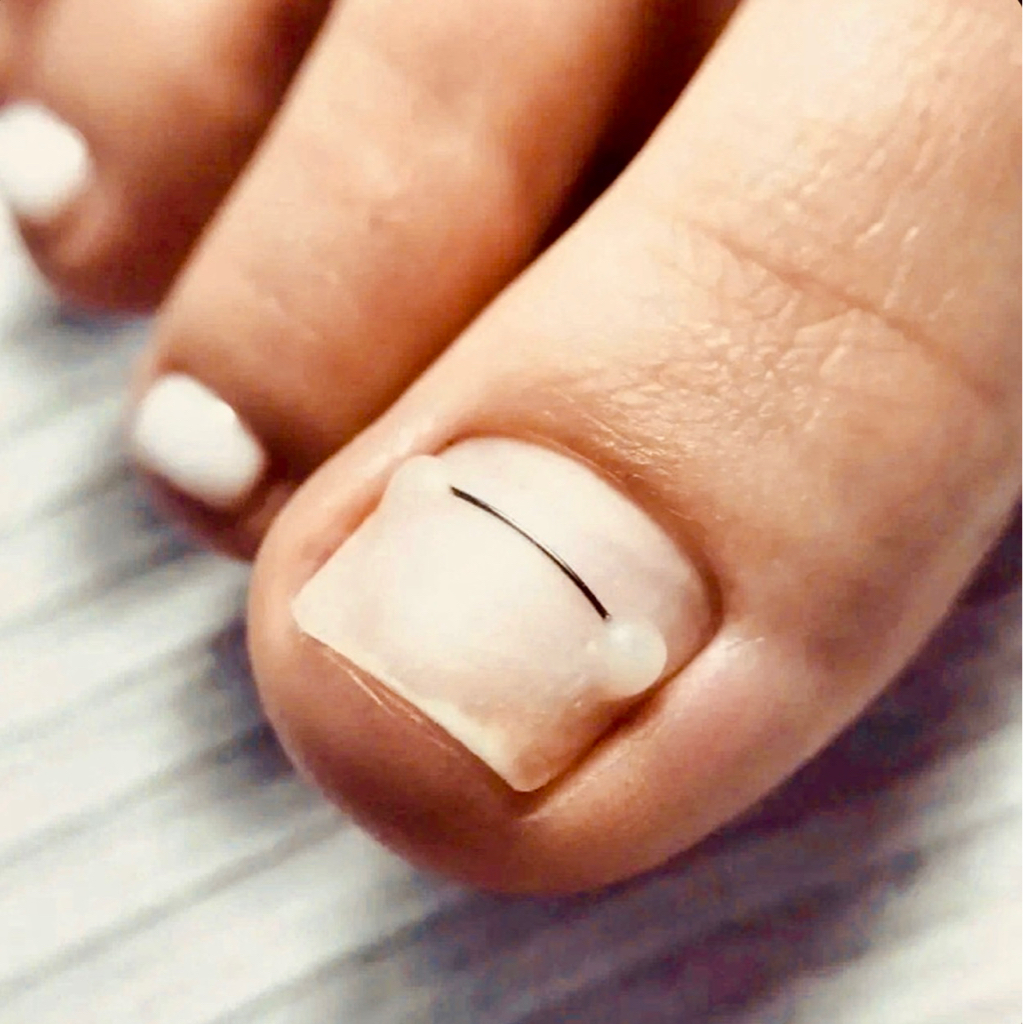 Коррекция вросшего ногтя системой ,,Титановая нить’’