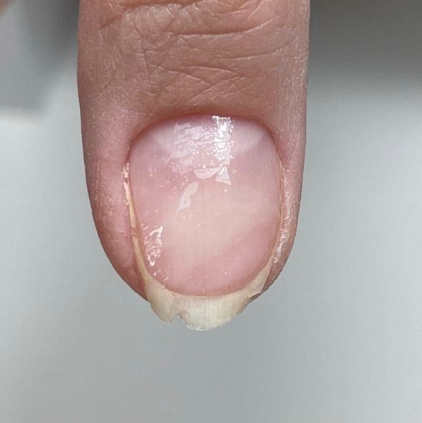 Ремонт ногтя