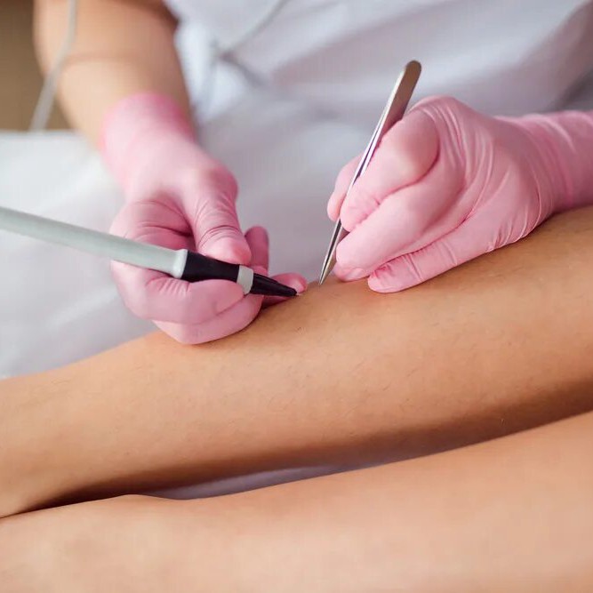 Электроэпиляция 2 часа НОВЫХ КЛИЕНТОВ НЕ БЕРУ