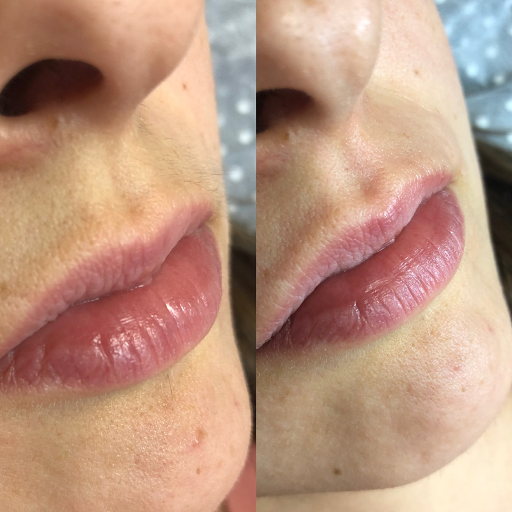 Зона над губой