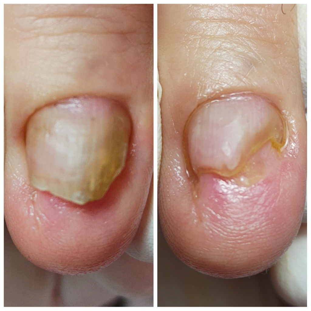 Повторная обработка поврежденного ногтя на руке