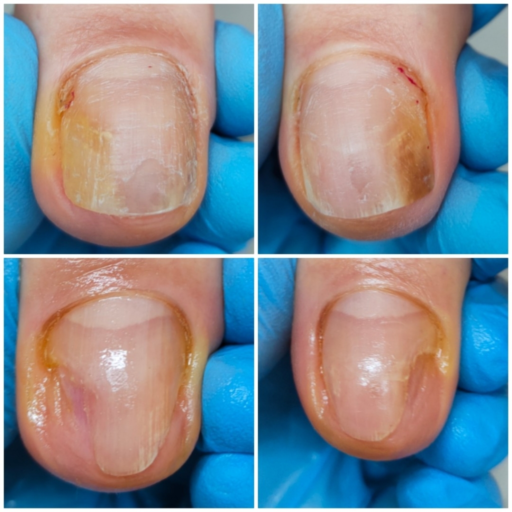 Обработка ногтей склонных к врастанию (все ногти)